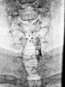 Right C5-6 Directed Epidural Injection
