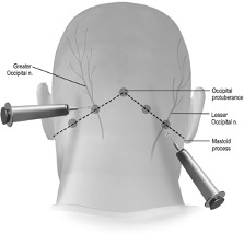 Occipital Nerve Block - Spine Care