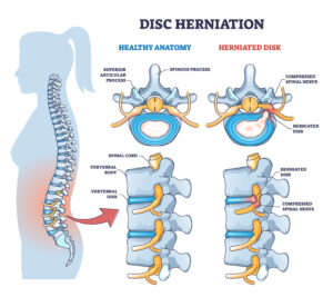 Disc herniation