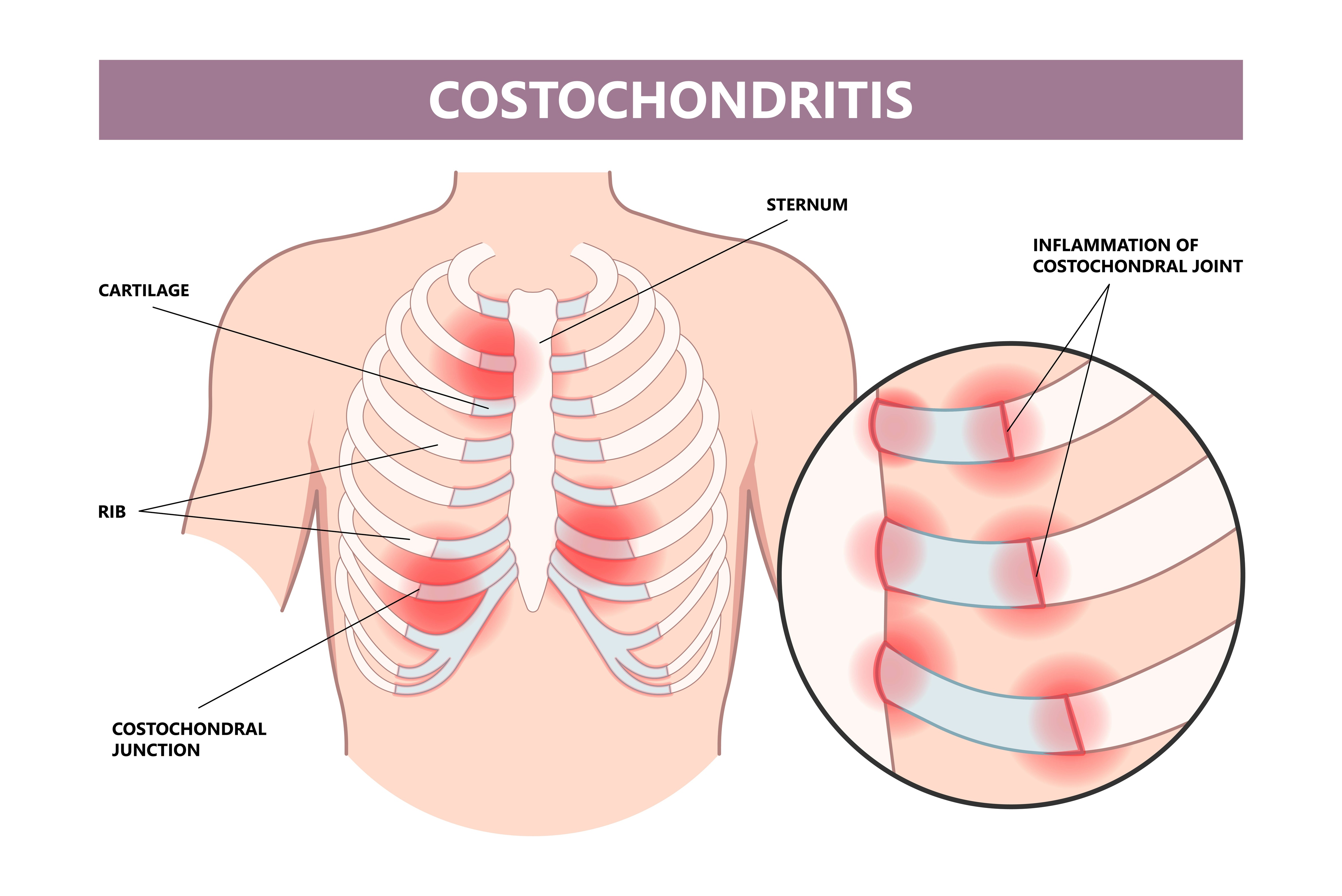 Costochondritis