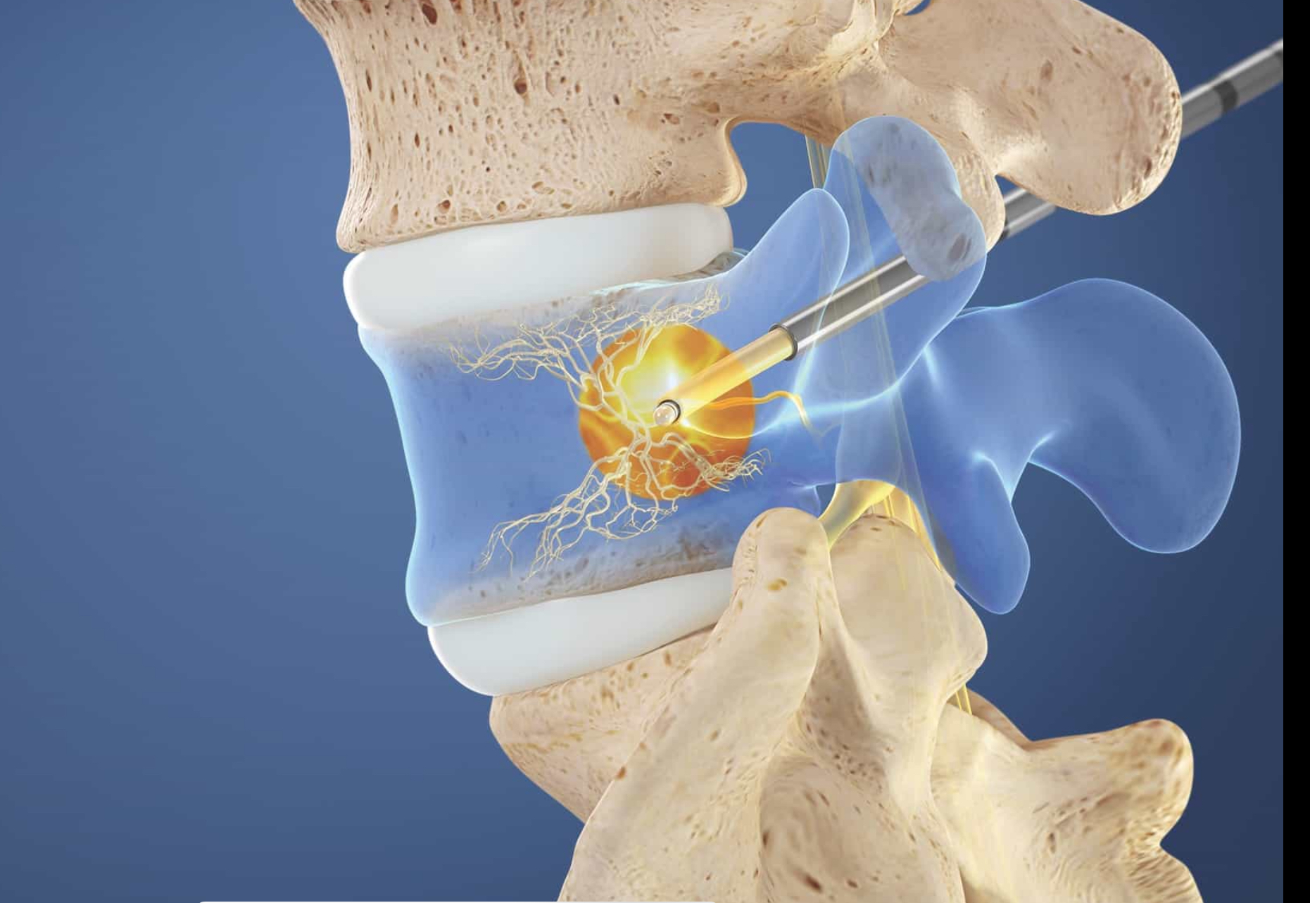 basivertebral Nerve Ablation