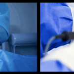Endoscopic Discectomy