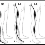 Radiculopathy
