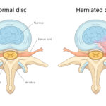herniated disc symptoms