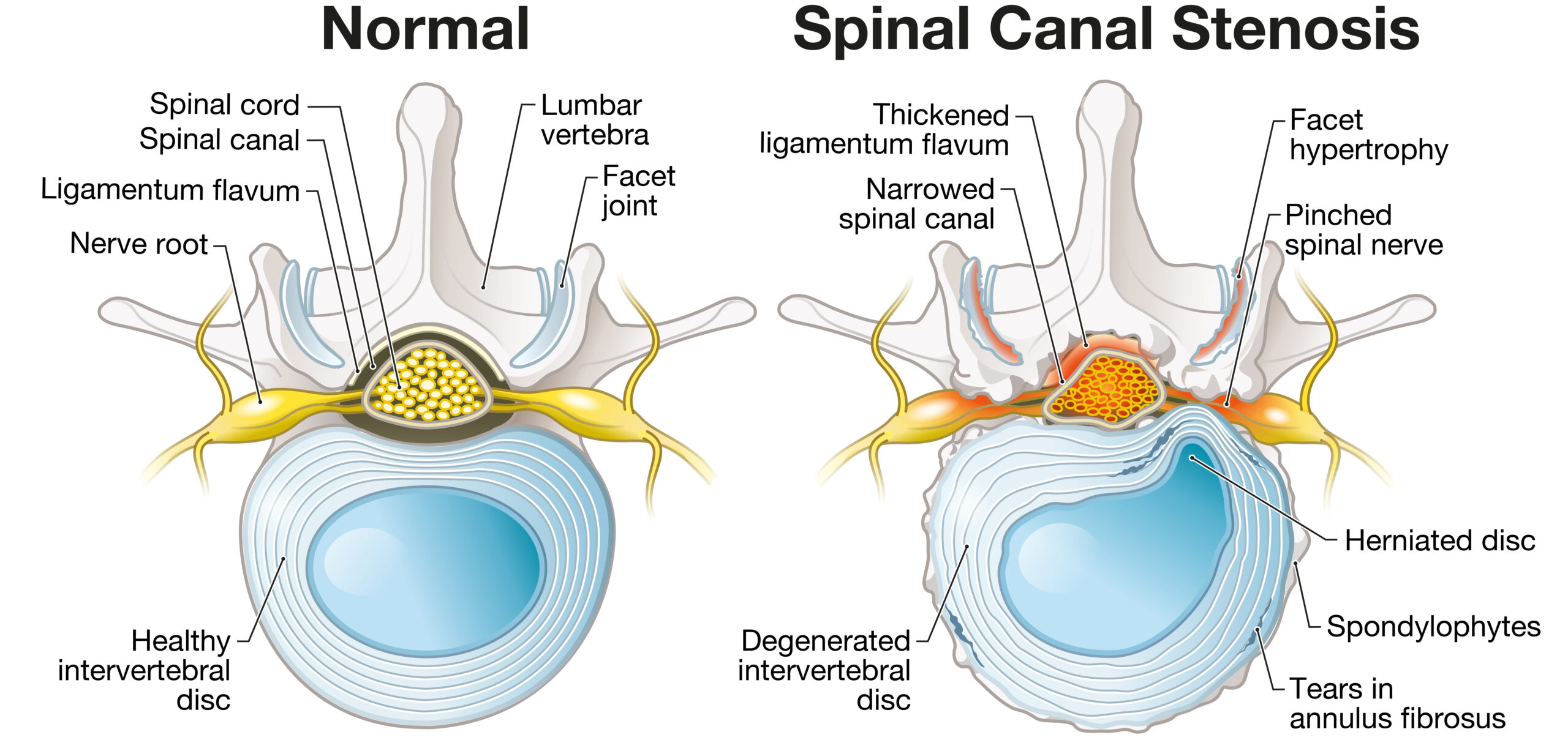 Illustration showing common causes of lumbar spinal stenosis including ligament thickening, facet arthritis, disc degeneration, and spinal canal narrowing