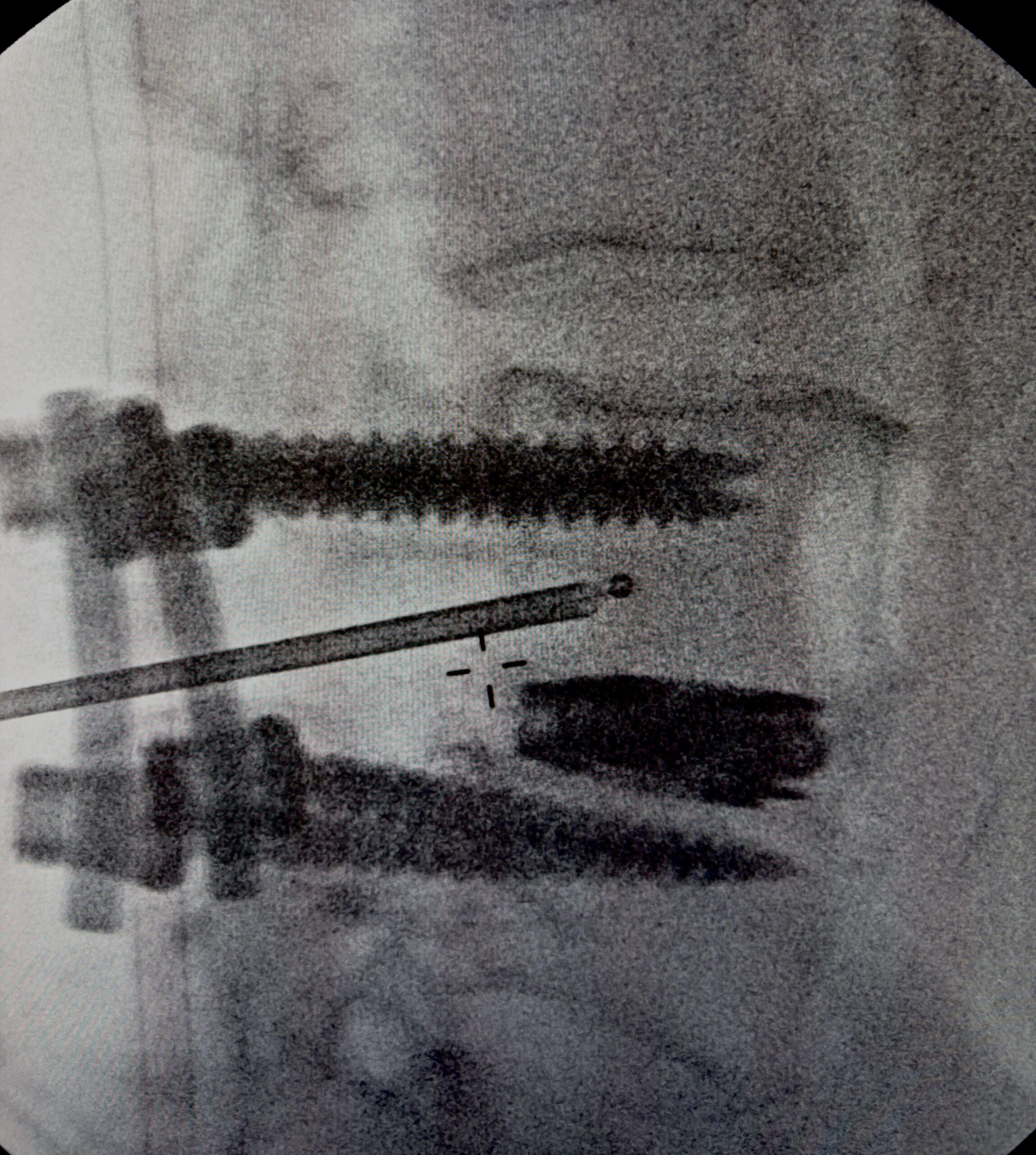 BVN ablation fluoroscopy - posterolateral access in post-fusion spine