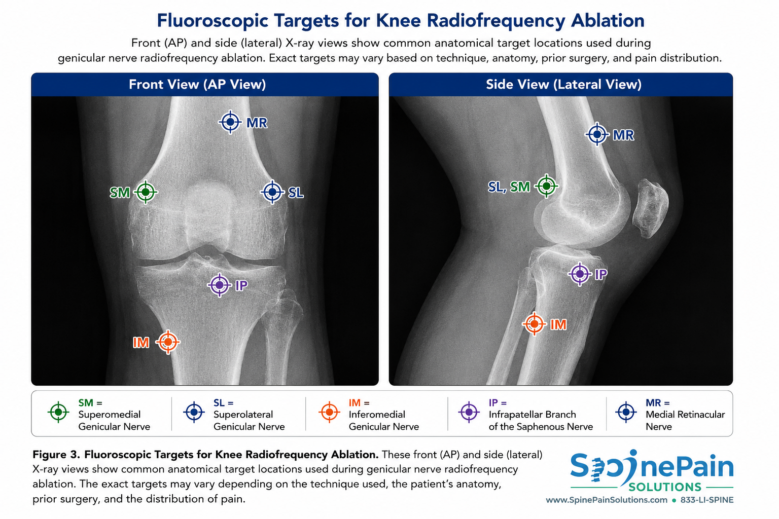 Front and side fluoroscopic views of a knee showing anatomical target locations used during genicular nerve radiofrequency ablation.