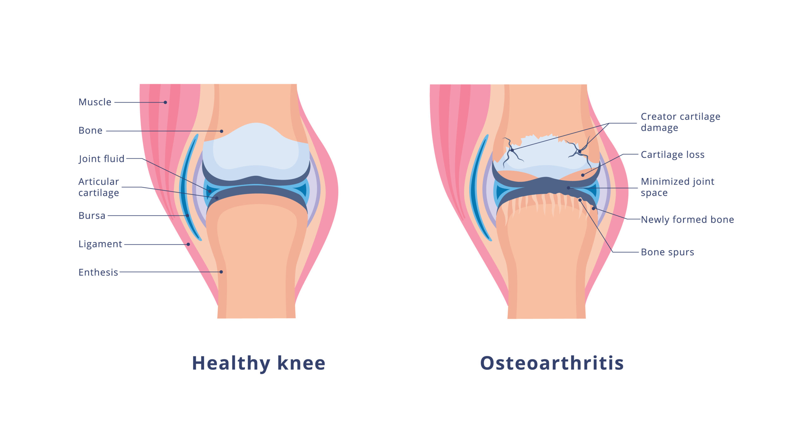 Comparison of a healthy knee and knee osteoarthritis showing cartilage loss, joint space narrowing, bone spurs, and degenerative arthritis.