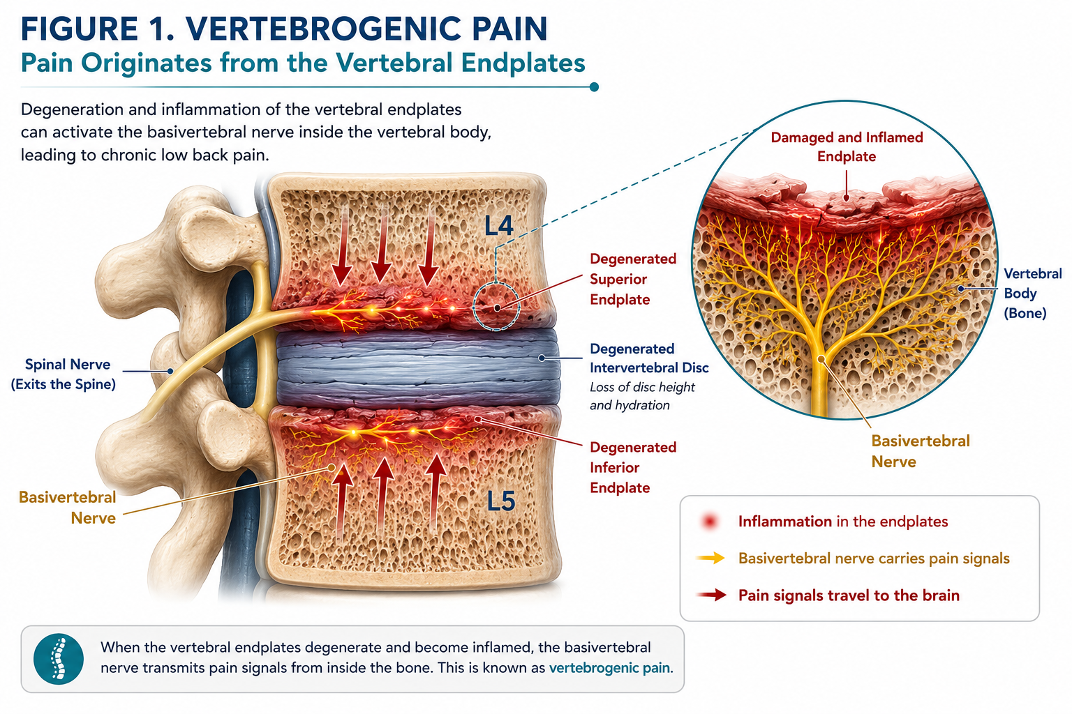 Illustration showing degenerative disc disease, damaged vertebral endplates, inflammation, vertebral marrow changes and activation of the basivertebral nerve in vertebrogenic pain.