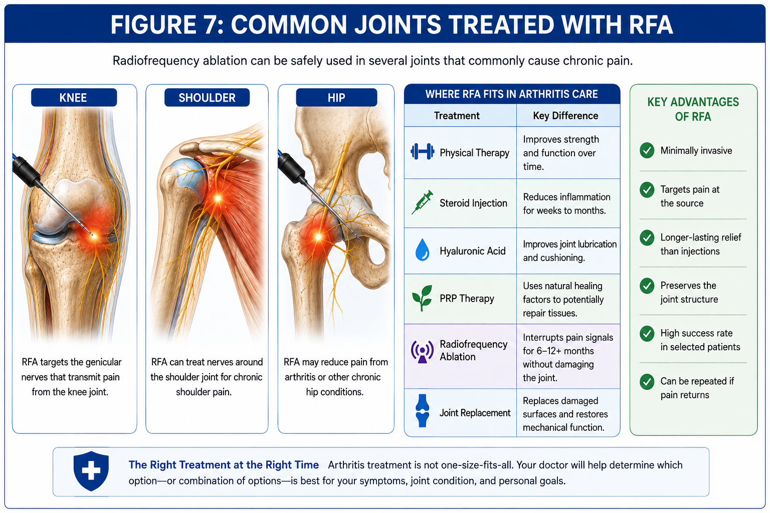 Medical infographic showing radiofrequency ablation for chronic knee, shoulder, and hip pain and explaining how RFA fits among physical therapy, injections, PRP, and joint replacement.