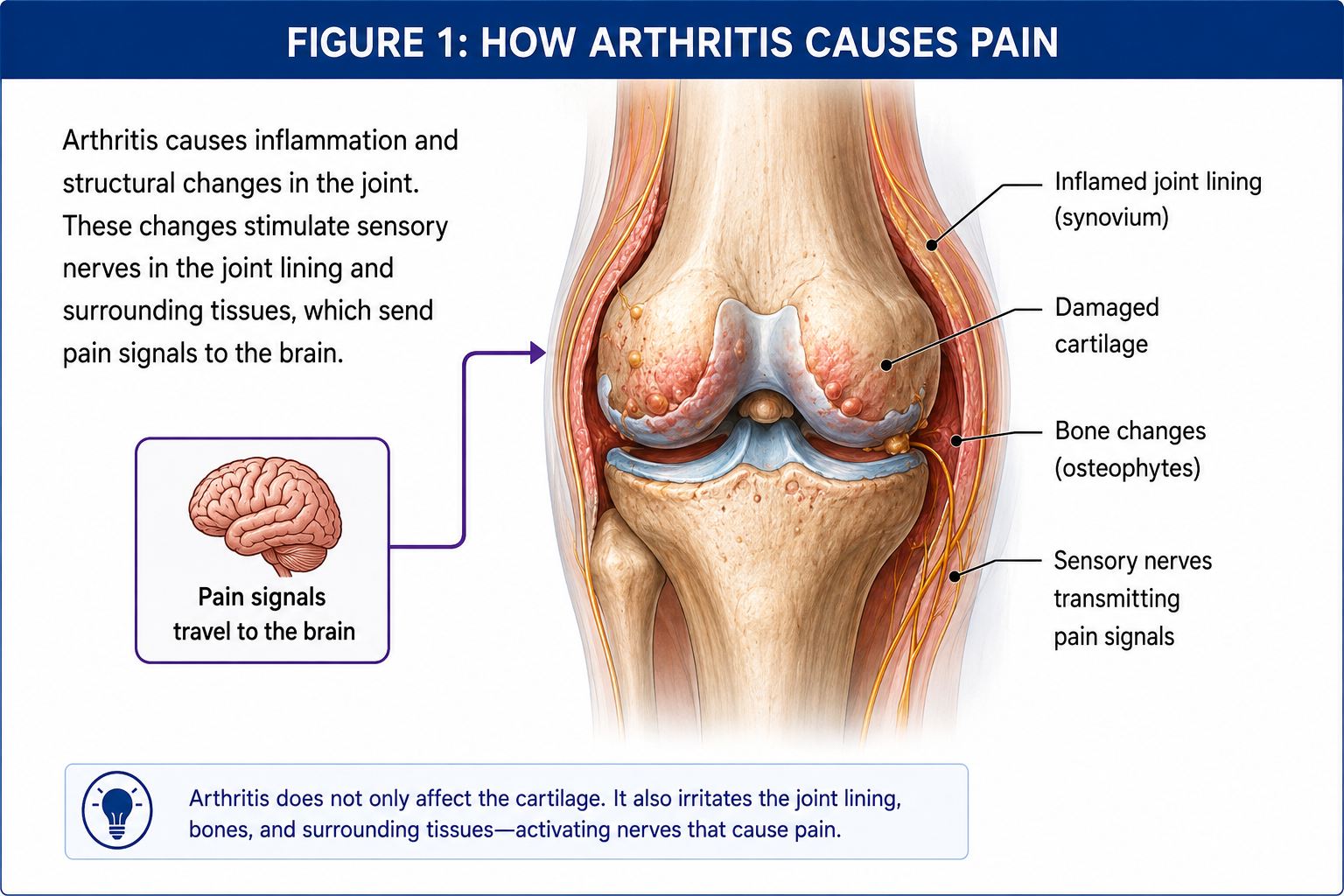 Medical illustration showing how inflammation, damaged cartilage, bone changes, and sensory nerves contribute to arthritis pain and transmit pain signals to the brain.