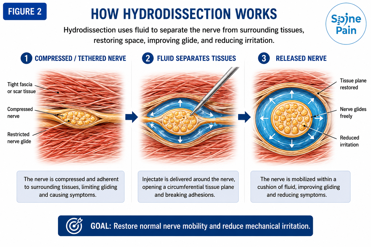 Medical illustration showing how nerve hydrodissection uses fluid pressure to surround a compressed nerve and physically separate it from surrounding scar tissue, fascia, or muscle.