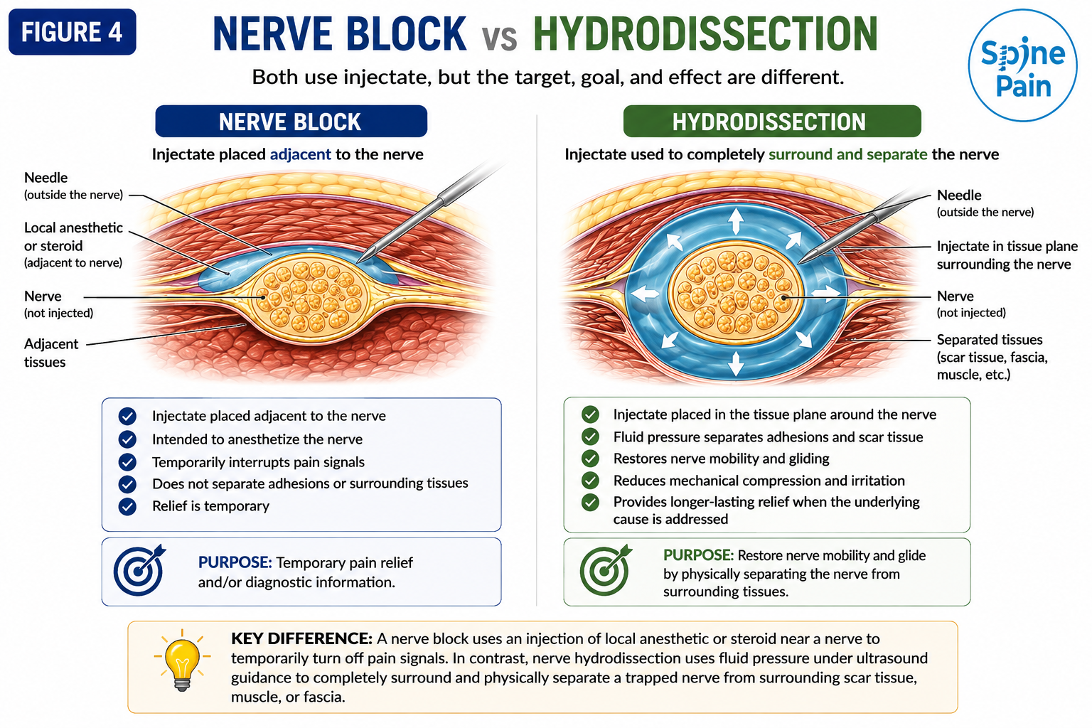 Medical illustration comparing a nerve block, where local anesthetic or steroid is placed near a nerve, with nerve hydrodissection, where fluid completely surrounds and physically separates a trapped nerve from surrounding tissues.