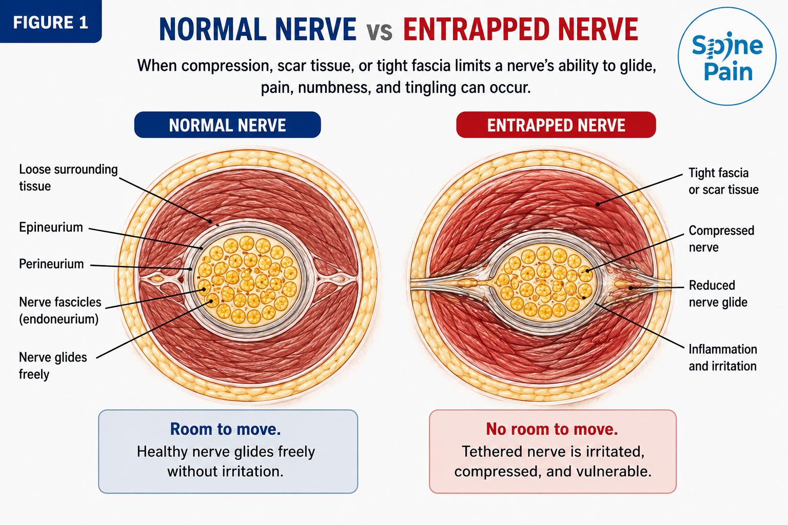Medical illustration comparing a normal peripheral nerve that glides freely with an entrapped nerve compressed by tight fascia or scar tissue.