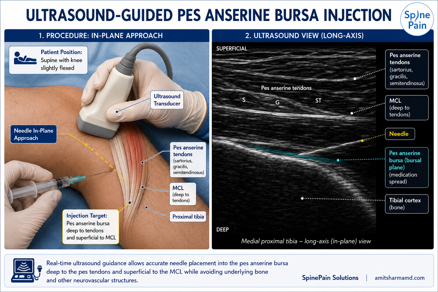 Ultrasound-guided pes anserine bursa injection showing medial knee positioning, in-plane needle placement, and ultrasound visualization of the pes tendons, medial collateral ligament, bursal plane, and tibial cortex.