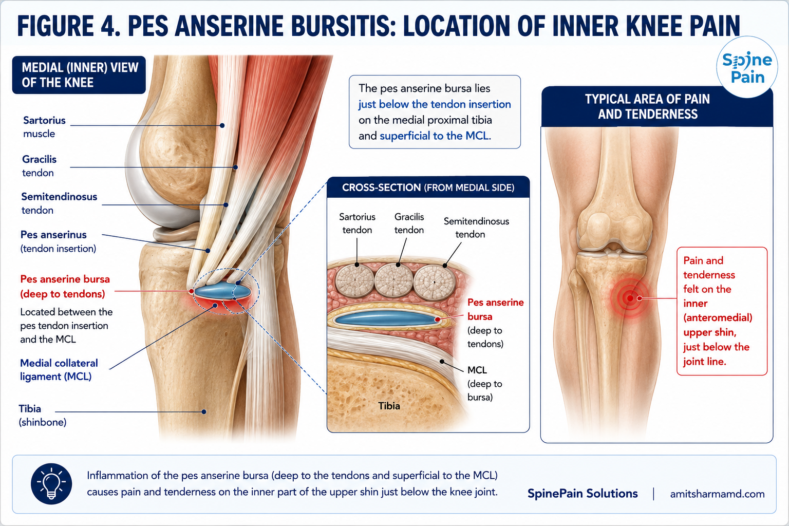 Medial knee illustration showing the pes anserine tendons, inflamed pes anserine bursa, medial collateral ligament, and typical location of pain along the anteromedial proximal tibia below the knee joint.