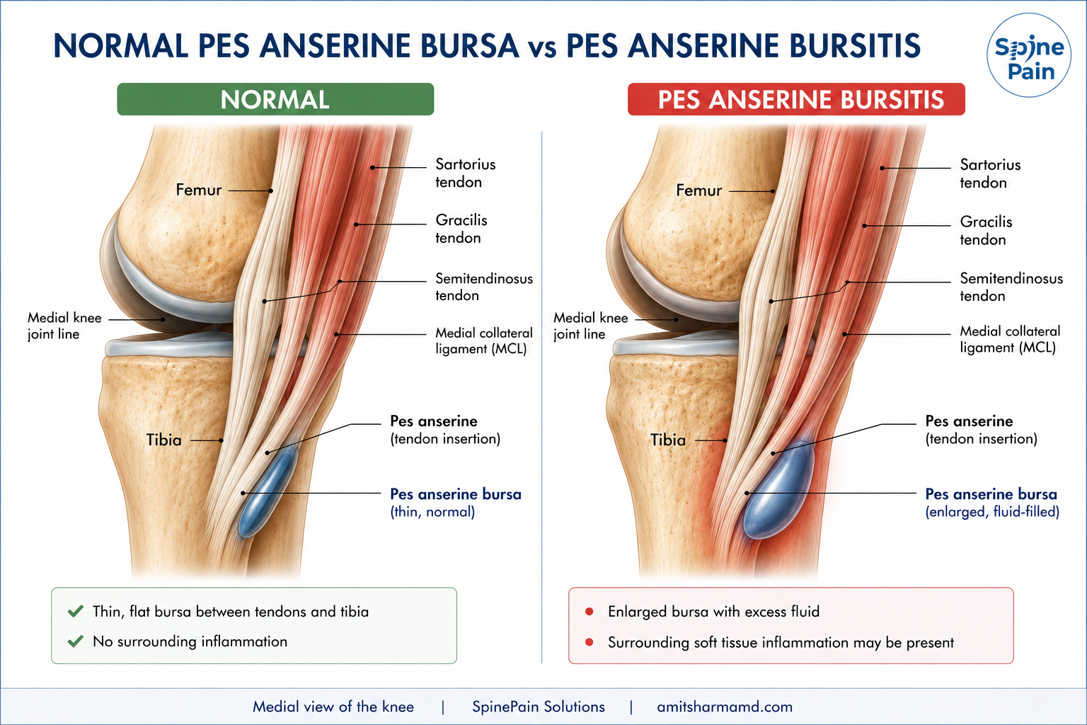 Comparison of a normal pes anserine bursa with an inflamed enlarged pes anserine bursa beneath the medial knee tendons.
