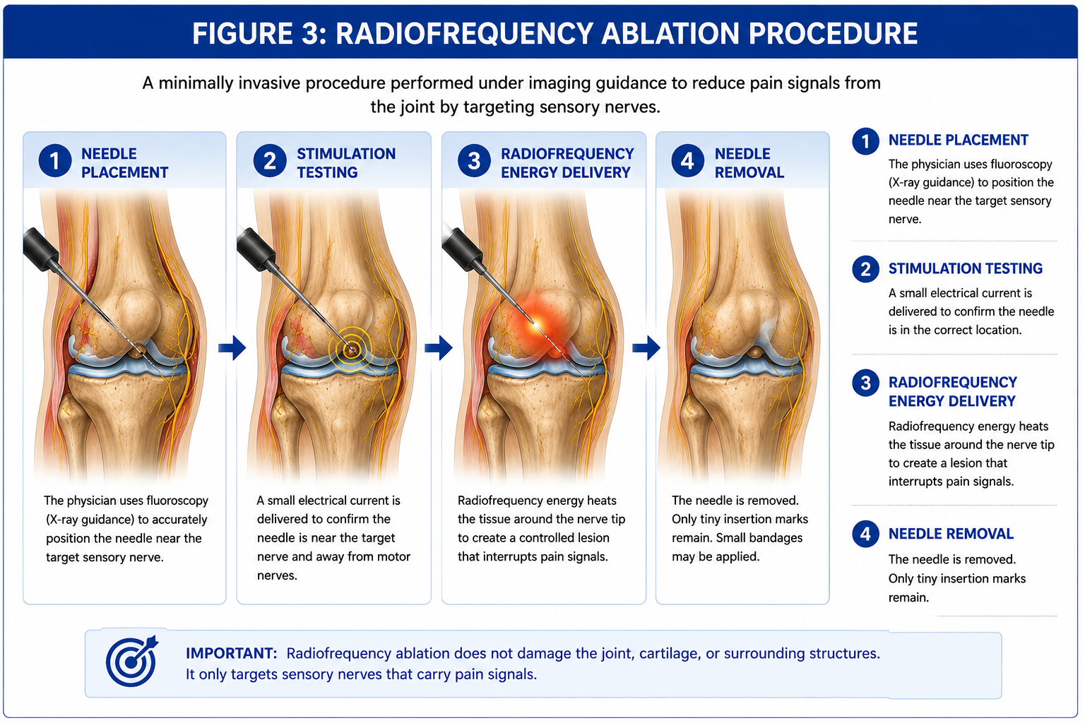 Step-by-step medical illustration showing needle placement, stimulation testing, radiofrequency energy delivery, and needle removal during joint radiofrequency ablation.