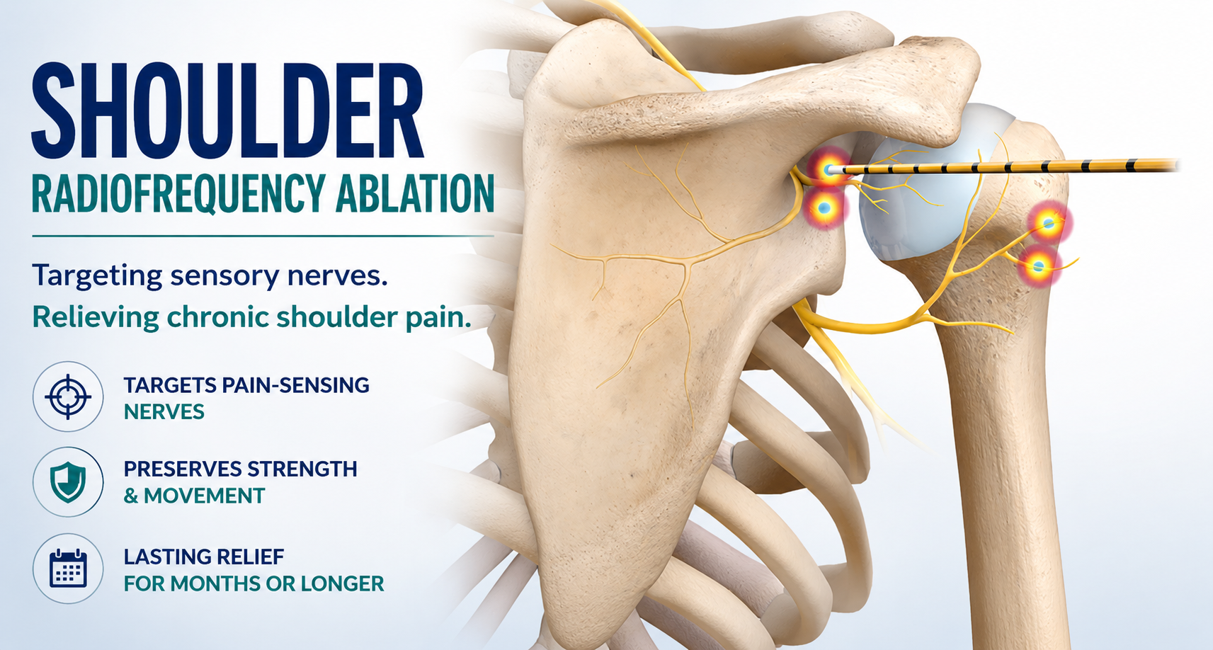 Illustration demonstrating radiofrequency ablation of the suprascapular, axillary, and lateral pectoral articular branches to interrupt shoulder pain while preserving the major motor nerves responsible for shoulder strength and movement.