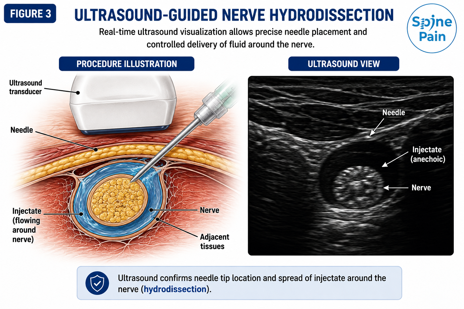 Medical illustration of ultrasound-guided nerve hydrodissection showing the needle positioned outside the nerve and fluid spreading around the nerve under real-time ultrasound visualization.