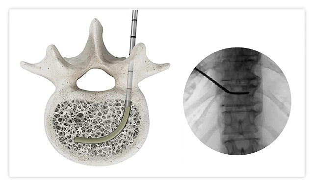 OmniCurve curved introducer and radiopaque sheath entering the vertebral body during kyphoplasty