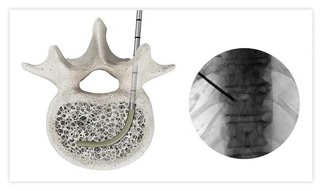 Radiopaque sheath remaining inside the vertebral body after removal of the OmniCurve introducer