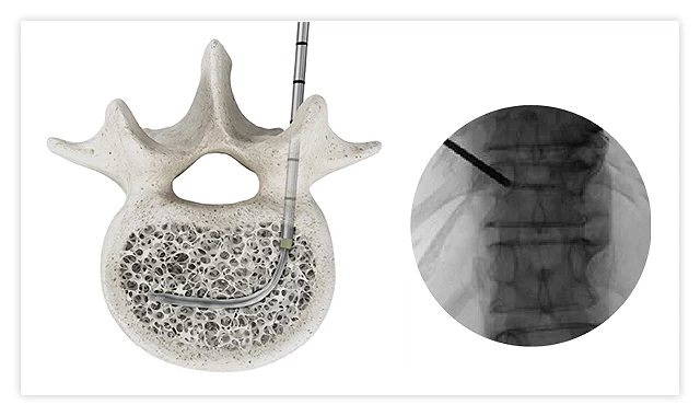 Kyphoplasty balloon advanced through the curved sheath into the fractured vertebral body
