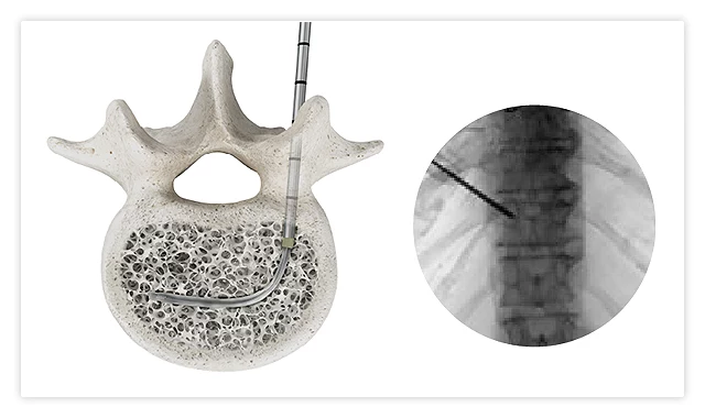 OmniCurve kyphoplasty balloon exposed by retracting the sheath inside the vertebral body