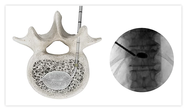 Balloon inflation creating a controlled cavity inside a vertebral compression fracture