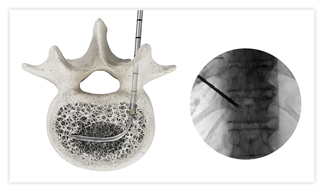 Deflated kyphoplasty balloon removed before controlled bone cement placement