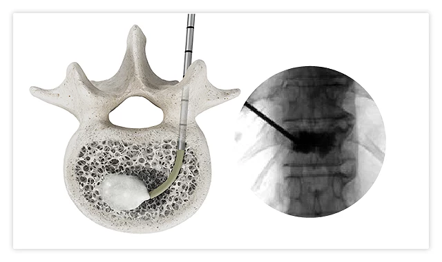 Controlled PMMA bone cement placement through a curved delivery system during kyphoplasty