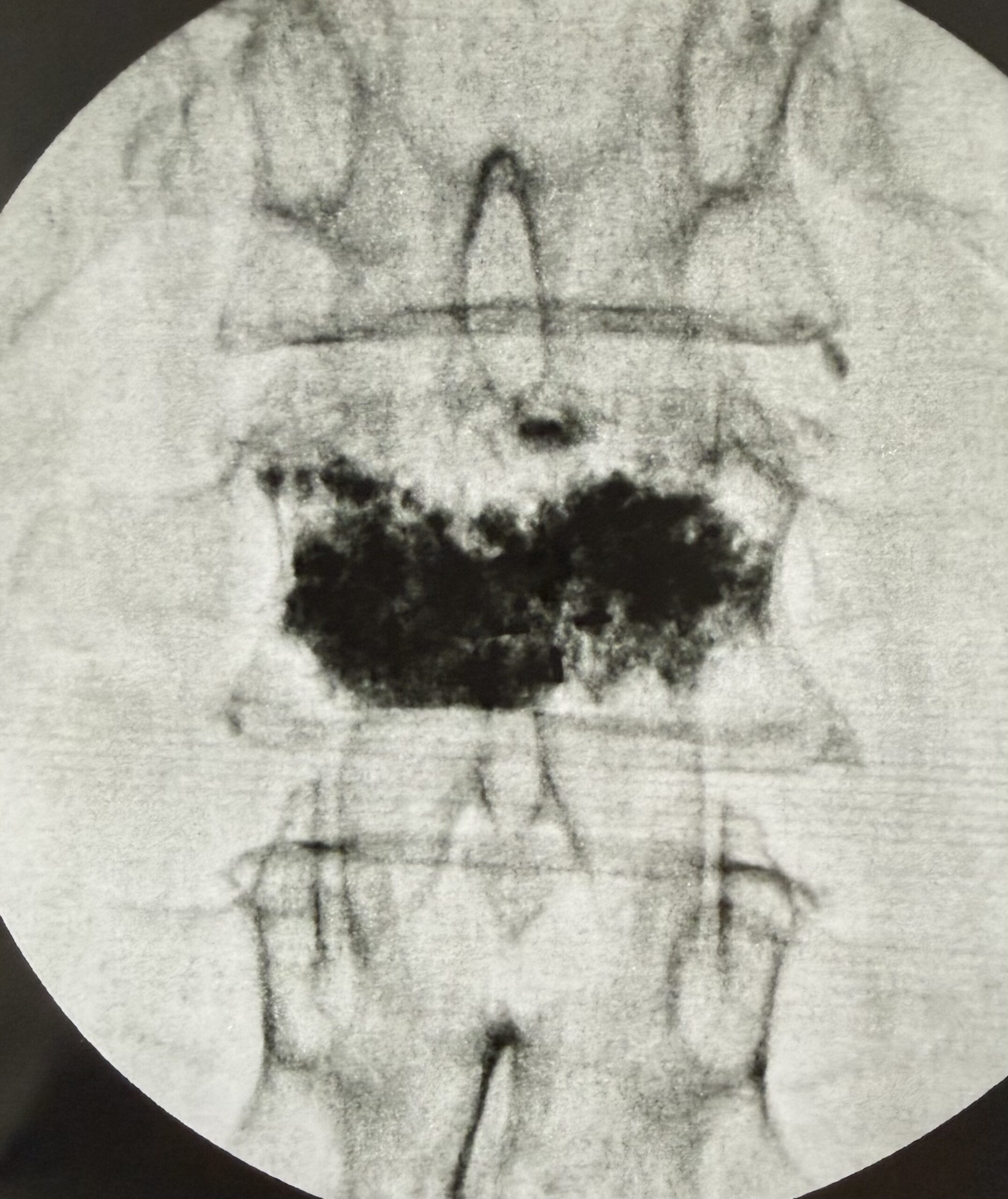 AP fluoroscopic view after kyphoplasty showing PMMA cement distribution within the treated vertebral body